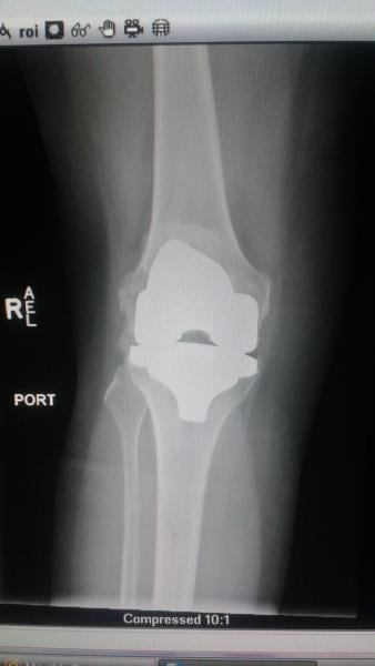 Marilyn Fornell's knee replacement as seen on ED X-ray.