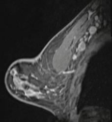 41-year-old woman who underwent high-risk screening breast MRI 15 days after first COVID-19 vaccination dose. Sagittal T1-weighted fat-saturated contrast-enhanced MRI shows extensive unilateral left level I-II axillary adenopathy. BI-RADS 3 was assigned.