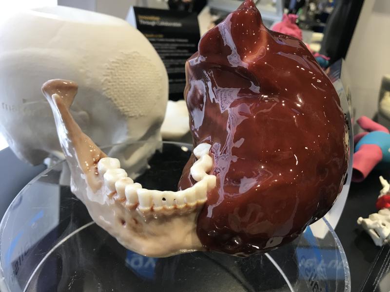 Example of life-like 3D printed tumor that is incorporated into a patient's jaw bone from Materialise. The vendor's software is FDA-cleared for use to print anatomy from CT or MRI studies that will be the exact size as the patient's actual anatomy. This can be used for planning and practicing complex surgical or interventional procedures and the model can aid navigation during procedures. 
