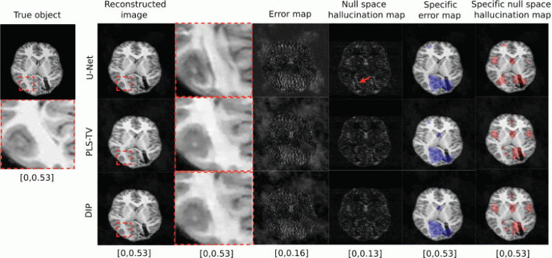 Example of true object and reconstructed images along with error map and hallucination maps (null space) for OOD data with different reconstruction methods – U-Net (top), PLS-TV (middle) and DIP (bottom). Expanded regions are shown to the right of the reconstructed images. The specific error map (blue) and specific null space hallucinations map (red) are overlaid on the reconstructed images for each method. The image estimated by the U-Net method has some distinct false structures (region within red boundin