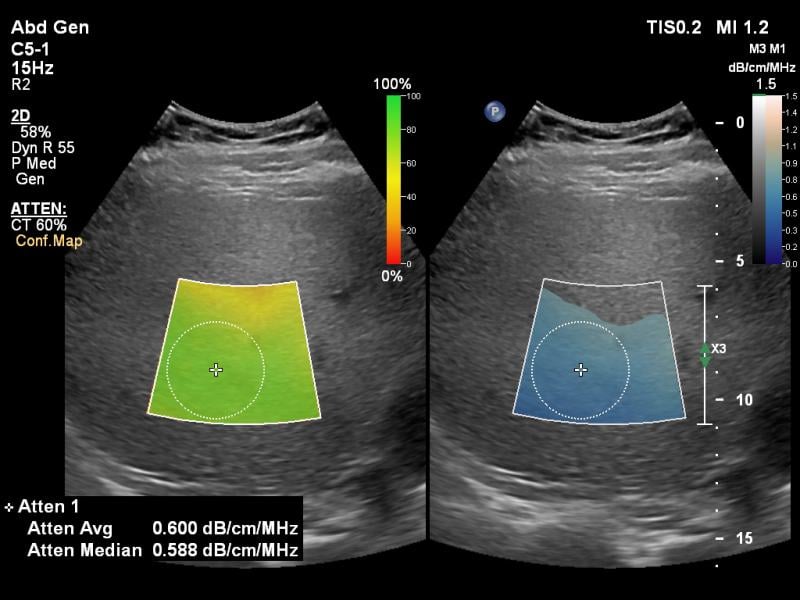 Philips Healthcare Epiq Ultrasound GI Liver