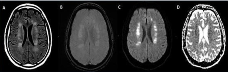 Acute anterior cerebral artery/middle cerebral artery watershed infarction seen in a 47-year-old male patient who presented with COVID-19 pneumonia. Image courtesy of RSNA