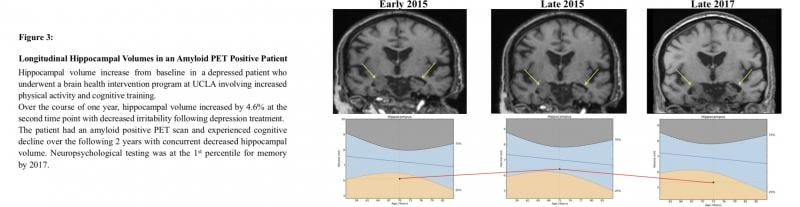 Hippocampal volume increase in depressed patient on MRI