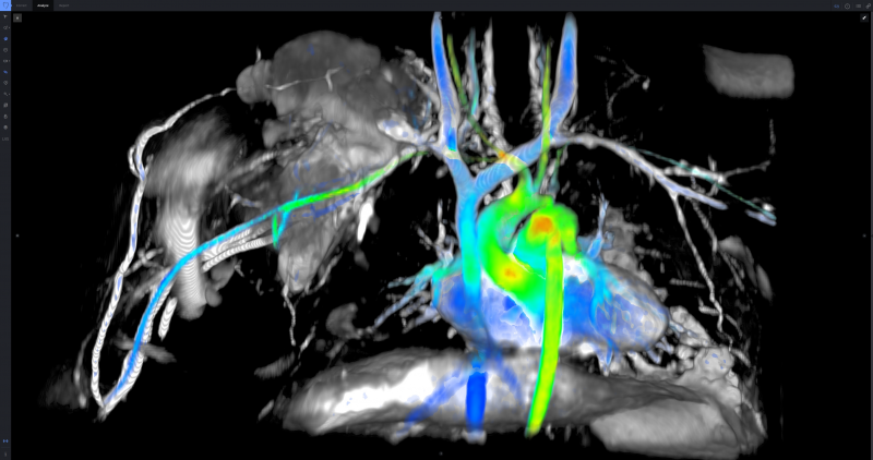 Arterys, ViosWorks, RSNA 2015, 3-D MRI, blood flow