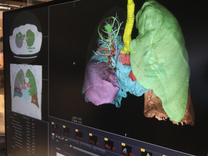 Ziosoft introduced a new lung nodule analysis application on its advanced visualization platform. 
