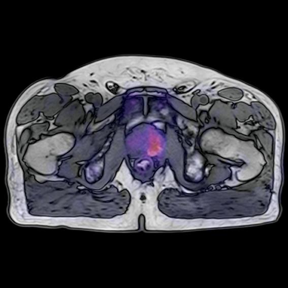 Prostate cancer image using PET/MR.