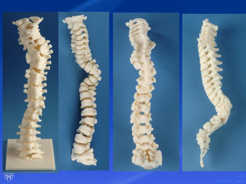 This 3-D printed spine recreation from the Mayo Foundation for Medical Education and Research enables physicians to study varying degrees of curvature of the spine.