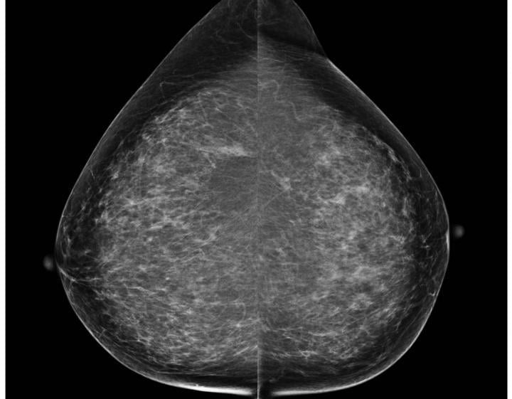 RSNA 2014, risk-based cancer screenings, mammography