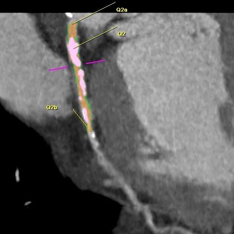 The Latest Advances in Coronary CT Angiography Software