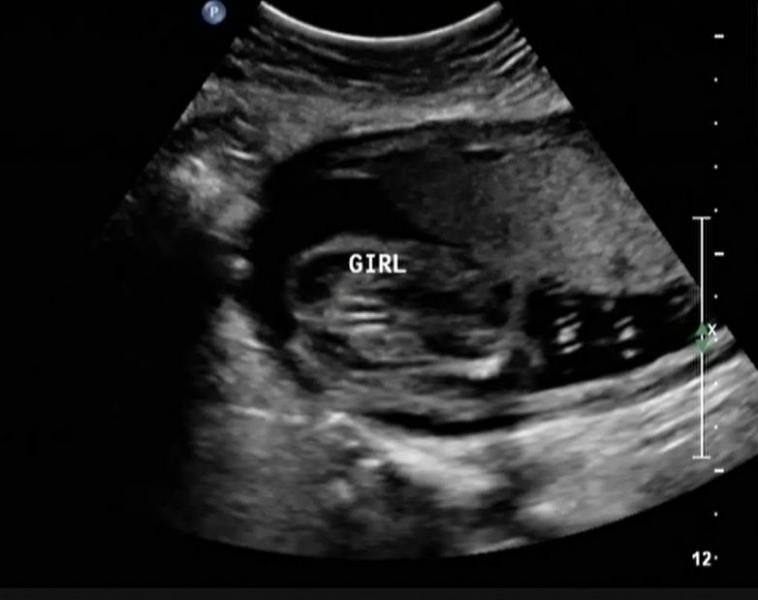 Ultrasound imaging can identify the sex of the baby by imaging the groin area. The penis on the male fetus appears as what is commonly called the "turtle" sign, which resembles like a turtle poking its head out of its shell. This image shows a female fetus with the "hamburger" sign created by the labia of the vagina. Katherine Fornell. How to tell the sex of a fetus, baby, on ultrasound.