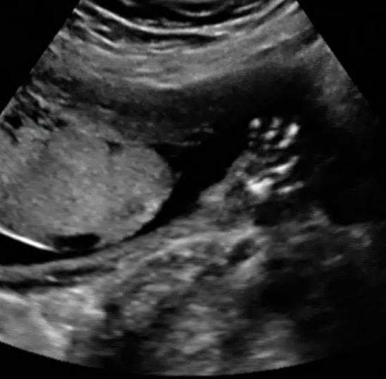 Fetal hand. Katherine Fornell. This is a baby ultrasound, also referred to as fetal ultrasound, OB ultrasound or prenatal ultrasound.