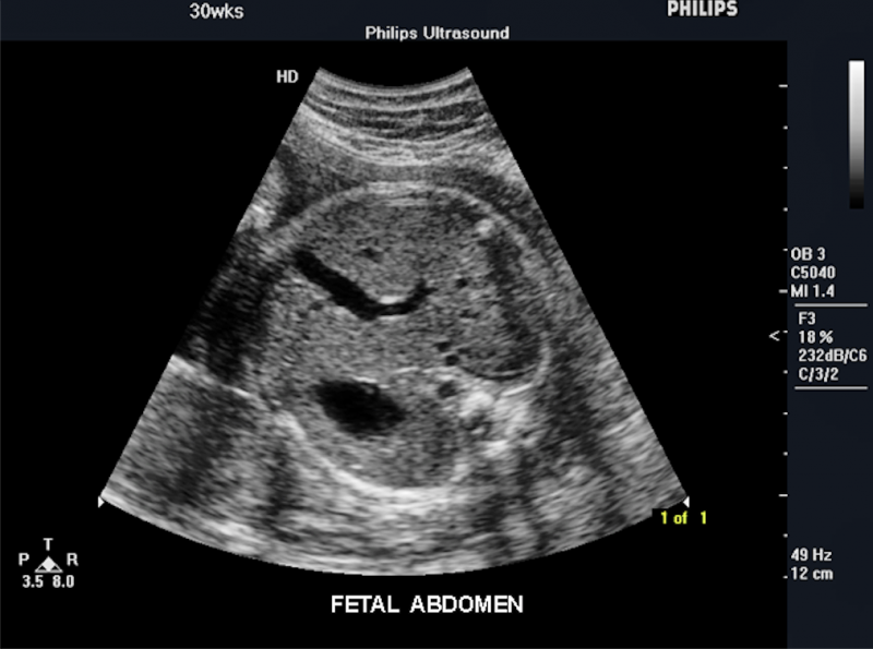 Fetal abdomen at 30 weeks. Imaged with a Philips Envisor system. This is a baby ultrasound, also referred to as fetal ultrasound, OB ultrasound or prenatal ultrasound.