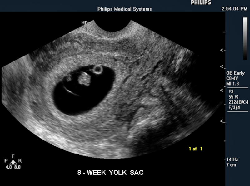 Fetal yoke sac as seen on ultrasound picture at eight weeks. Imaged with a Philips Envisor system. This is a baby ultrasound, also referred to as fetal ultrasound or prenatal ultrasound. 