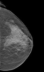 digital breast tomotherapy image with dense mass