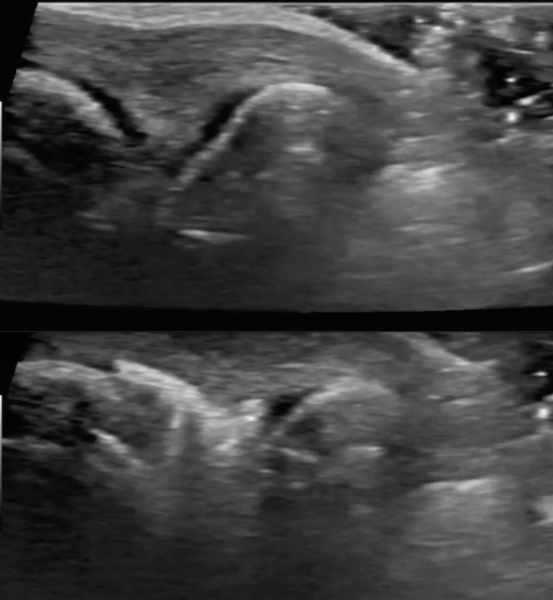 knuckle cracking, ultrasound study, RSNA 2015