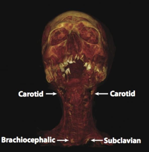 Mummy CT scans showing 3-D rendering showing a mummy with calcification in the carotid arteries.