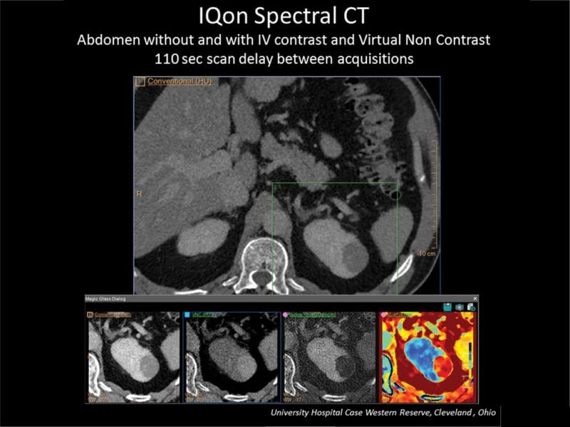 The abdominal scan to the left is demonstrating Spectral Magic Glass and the ability to create multiple spectral views to enhance a kidney mass. Spectral imaging enables iodine to be removed to create virtual non-contrast views.