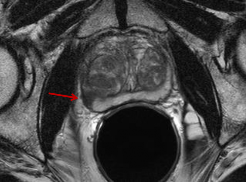  Prostate MRI showing tumor 2_From Philips MRI webinar for ITN