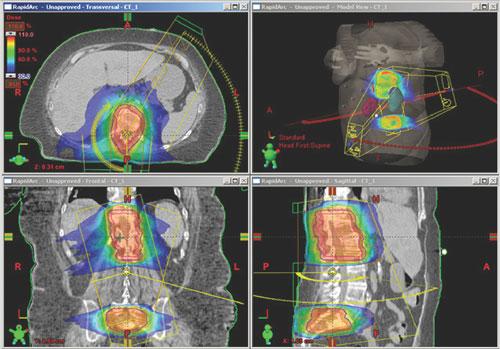 Varian Eclipse Proton Therapy Treatment Planning for a Spinal case.