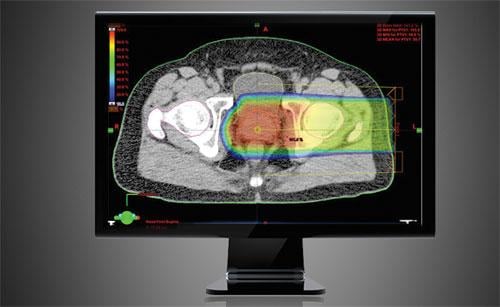 Proton therapy using the eclipse proton treatment planning system for a prostate.