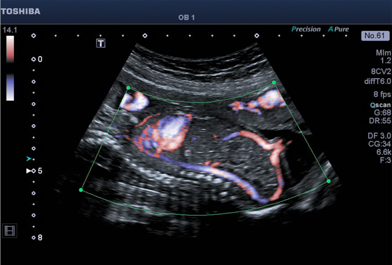 Image of blood flow in the fetal abdomen. Imaged using Canon's Aplio 500 Advanced Dynamic Flow (ADF) feature, which displays true blood flow. Baby picture of ultrasound showing Doppler Bloodflow