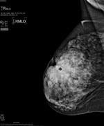 CAD Gives a Boost to Breast Imaging