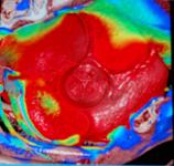 Tissue strain from cardiac motion can be seen in red around this aortic valve using a filter in the Phyziodynamic software.