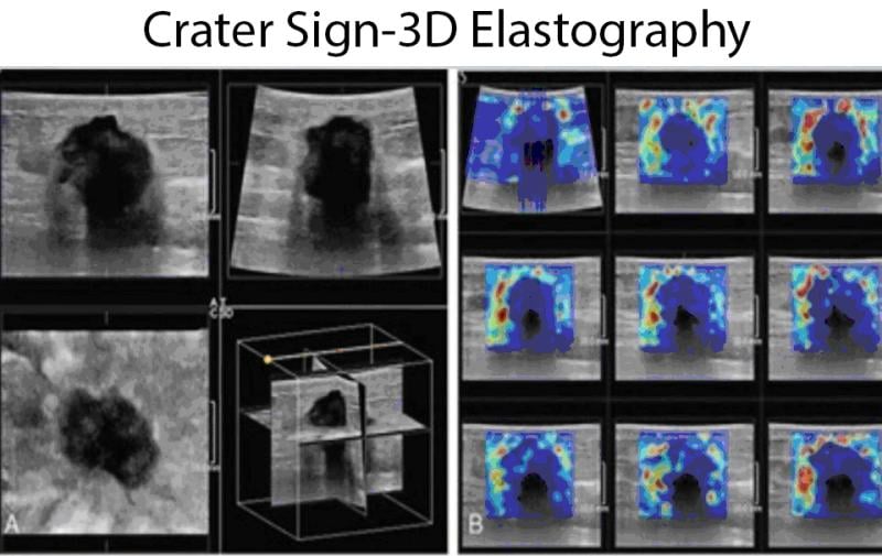 Figure 1.  Left black and white coronal ultrasound shows irregular “donut” periphery corresponding to desmoplastic tissue, while the right colored elastography demonstrates the fibrotic elements creating the “crater” interior. 