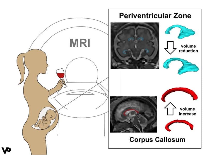 Figure 2. Graphical abstract: effects of prenatal alcohol exposure (PAE). PAE leads to a volume reduction in the periventricular zone and a volume increase in the corpus callosum.