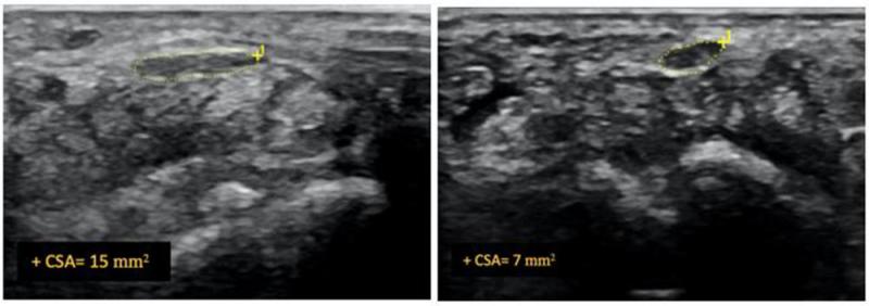 Figure 2. Ultrasound image of median nerve before and after hydrodissection procedure in a patient with carpal tunnel syndrome. This case had cross-sectional area of 12 mm2 pre-procedure that reduced to 7 mm2 post-procedure (dashed yellow lines depicting the median nerve).