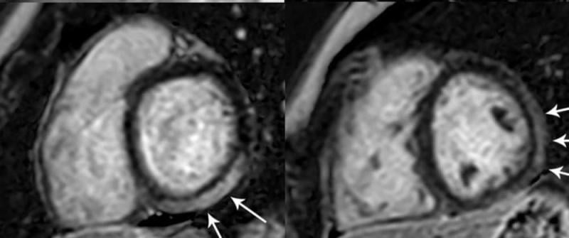 Figure 3. MRI shows Prominent LGE involving more than 50% of the myocardium in the basal inferolateral and inferior segments of the left ventricle and in the anterolateral, inferolateral, and inferior segments of the left ventricle at the midventricular level in adolescent female. Note: this image is for illustrative purposes only and is not associated with the Big Ten study group. Image courtesy of Radiology: Cardiothoracic Imaging.