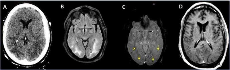 Figure 8. 65-year-old male smoker, presented with acute hypoxic respiratory failure secondary to COVID-19 pneumonia, requiring intubation. Hospitalization was complicated by seizures relating to cerebral edema and hemorrhagic posterior reversible encephalopathy syndrome.