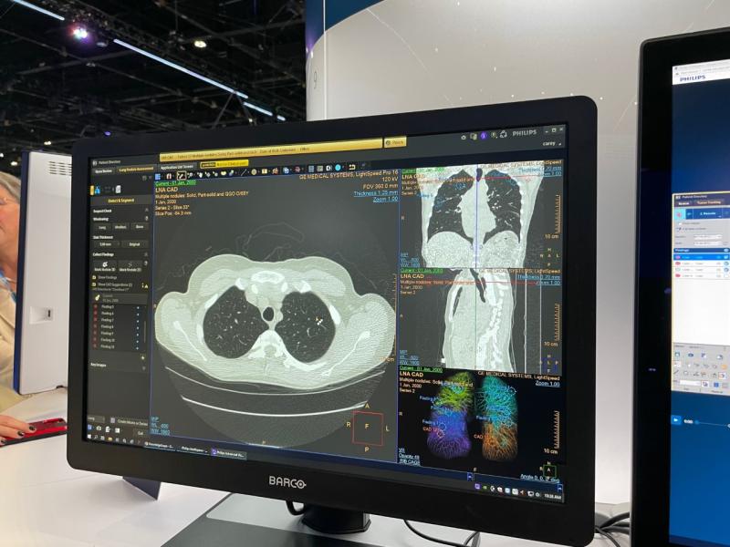 At RSNA, Philips introduced its next-generation Advanced Visualization Workspace platform with AI-enabled algorithms and workflows. This latest innovation is vendor-neutral, providing a single, advanced platform for multiple modalities across cardiology, oncology, neurology, and radiology with a comprehensive suite of advanced visualization solutions to support care teams, and tailored to fit the needs of any hospital network, from a single workstation to an enterprise solution.