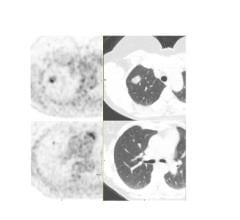 Staging F-18 FDG PET/CT images of adenocarcinoma in the RUL of the lung illustrates the value of Vereos. The primary lesion in the right upper lobe appears in the upper row (PET image is left, CT image is right). A 3 mm synchronous primary or metastatic lesion in the RUL is apparent in the lower row. The precision afforded by Vereos' images provided the basis for the patient to undergo RUL lobectomy instead of thermal ablation of the primary lesion. Images courtesy of Dr. Jay Kikut and UVM
