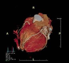 A new study showed that a non-invasive imaging test can help identify patients with coronary artery blockage or narrowing who need a revascularization procedure