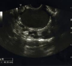 A new Society of Radiologists in Ultrasound (SRU) expert consensus statement to improve endometriosis evaluation was published