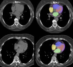 AI is applied to CT scans to automatically segment different heart chambers and quantify arterial plaque