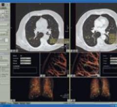 CT scanning for lung cancer CAD software for multislice CT.