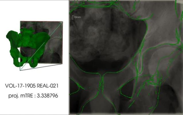 Aligned 3D model (left) and the projection of the 3D model with the X-ray image (Right)