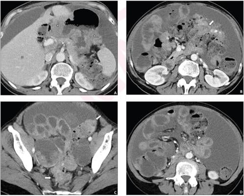 62-year-old woman who underwent pretreatment CT for suspected advanced ovarian cancer.