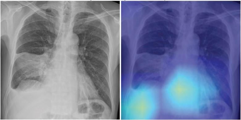 Adeep learning-based model using initial chest radiographs predicted 30-day mortality in patients with community-acquired pneumonia (CAP), improving upon the performance of an established risk prediction tool (i.e., CURB-65 score). 