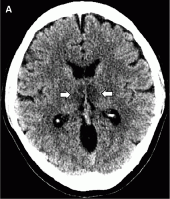 #COVID19 #Coronavirus #2019nCoV #Wuhanvirus #SARScov2 A brief article from Henry Ford Health System in Detroit, published today in Radiology, reports on the first presumptive case of COVID-19–associated acute necrotizing hemorrhagic encephalopathy.