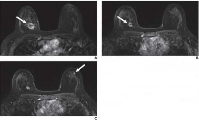A, Contrast-enhanced axial T1-weighted fat-saturated image from baseline MRI before initiation of neoadjuvant therapy shows irregular mass (arrow) in upper inner right breast corresponding to biopsy-proven carcinoma. B, Contrast-enhanced axial T1-weighted fat-saturated image from follow-up MRI performed 3 months after initiation of neoadjuvant therapy shows decrease in size of right breast cancer (arrow). C, Contrast-enhanced axial T1-weighted fat-saturated image 3 months after initiation of neoadjuvant the