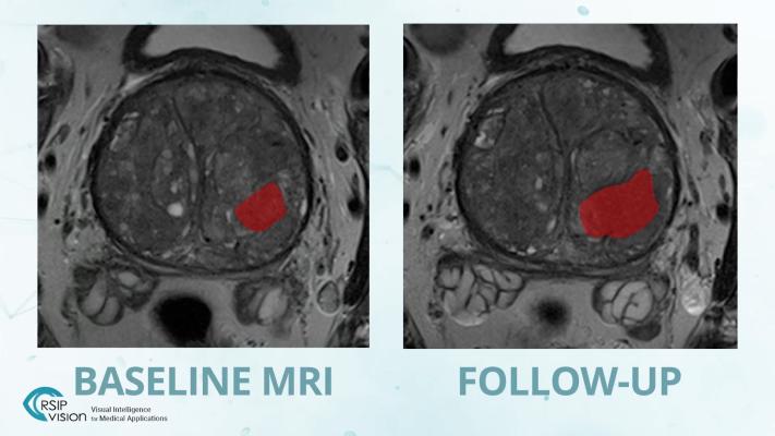 RSIP Vision, an experienced leader in driving innovation for medical imaging through advanced artificial intelligence (AI) and computer vision solutions, announced a new tool for prostate MRI analysis. 