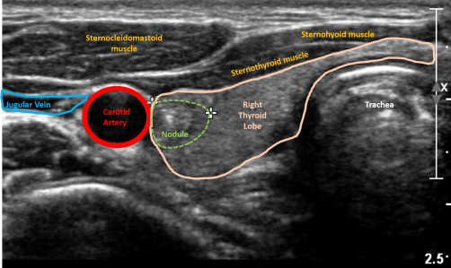 Using artificial intelligence to predice risk of thyroid cancer on ultrasound.
