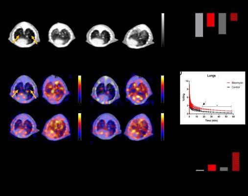 Positron emission tomography (PET) using a 68Ga-labeled fibroblast activation protein inhibitor (FAPI) can noninvasively identify and monitor pulmonary fibrosis, according to research presented at the Society of Nuclear Medicine and Molecular Imaging 2021 Annual Meeting.