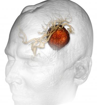 low-grade brain tumors, gliomas, UC San Diego, survival rates up, adults