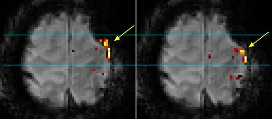 7T MRI Provides Precise 3-D Maps of Brain Activity