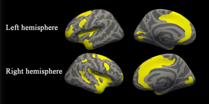 MRI Uncovers Brain Abnormalities in People With Depression and Anxiety