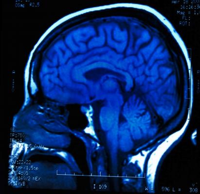 pain patterns, brain scans, fMRI, JAMA Neurology study